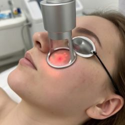 co2laser co2laser