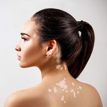 Vitiligo Surgery in Patna